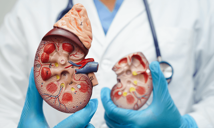 CPN 2025: Nefrolitíase frente ao aquecimento global: dificuldades de interpretação