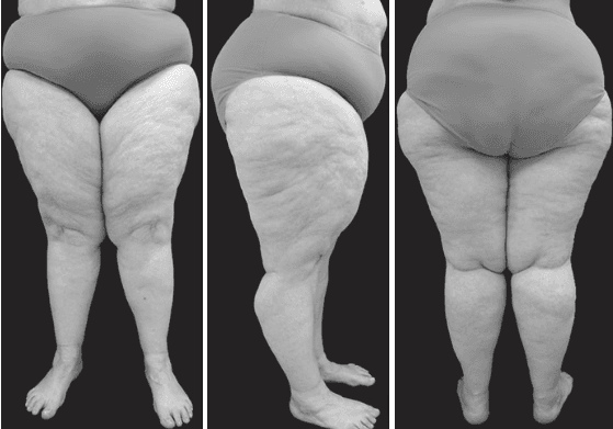 Principais pontos do Consenso Brasileiro sobre Lipedema