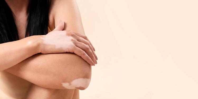 Ruxolitinibe creme: uma novidade no tratamento do vitiligo!