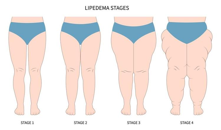 Terapia Hormonal em Mulheres com Lipedema: Há Risco Aumentado ou Mito?