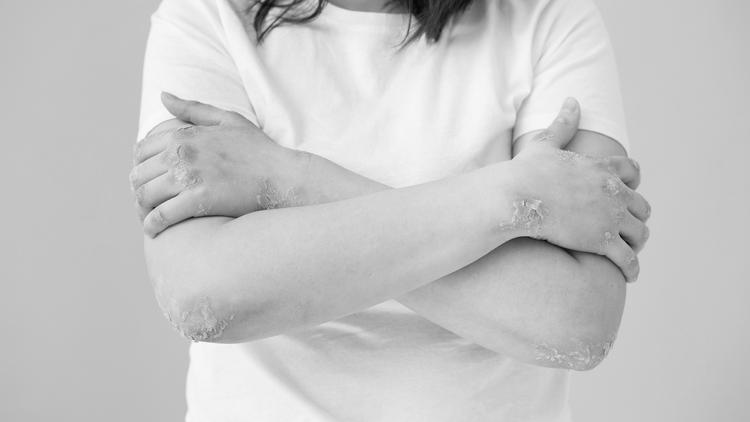 Relação bidirecional entre uveíte e psoríase: revisão sistemática e meta-análise