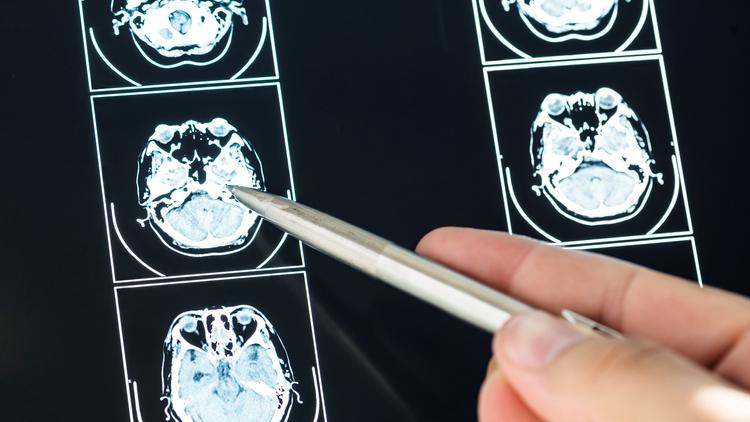 Nimodipina oral vs intraventricular na HSAa: o que dizem as evidências?