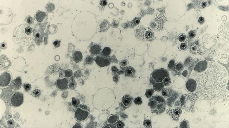 Infecção por citomegalovírus e manifestações cutâneas