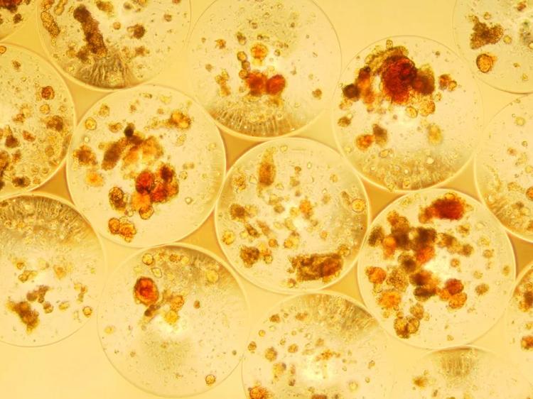 Impacto do transplante de ilhotas em complicações e mortalidade no DM1