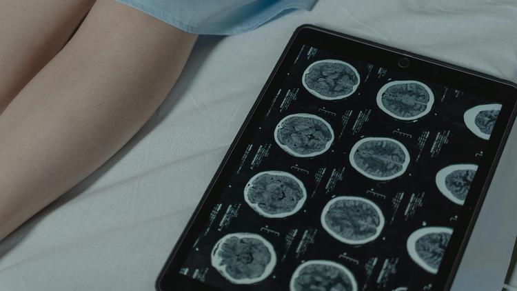 Anvisa autoriza novo tratamento oral para tumores cerebrais