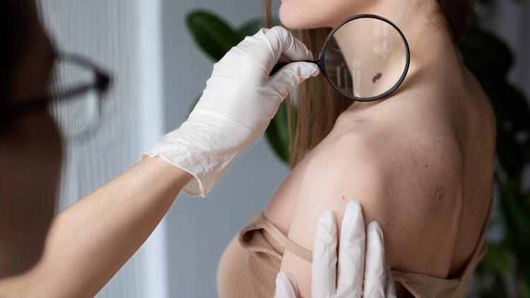 Melanoma: O impacto da pandemia de covid-19 no diagnóstico