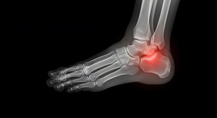 fixação percutânea