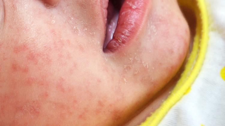 Casos de sarampo disparam nas Américas e aumentam 34 vezes em 2025, alerta Opas