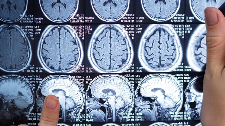 Desmielinização aguda do sistema nervoso central: Desvendando a causa em crianças