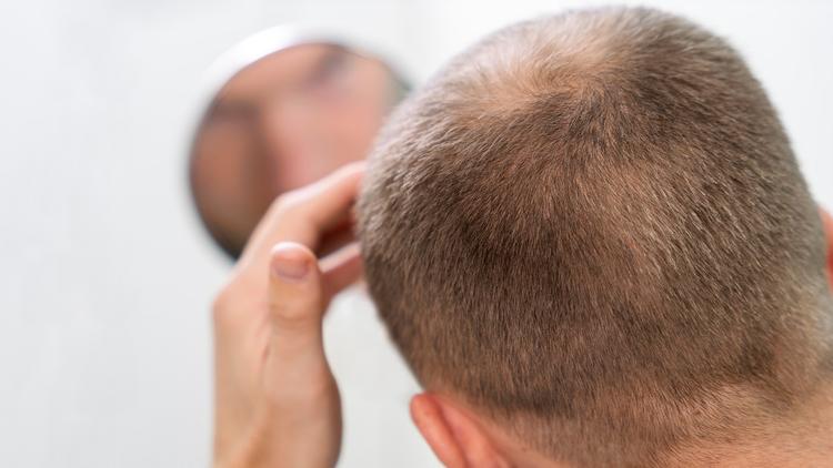 Inibidores de JAK no tratamento da alopecia areata: avanços e perspectivas