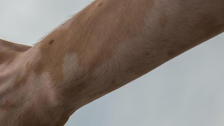 Vitiligo e inibidores de JAK: O que devemos saber?