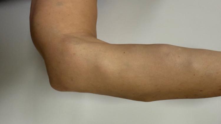 Caso clínico: Lipomas múltiplos pelo corpo: o que pode ser?