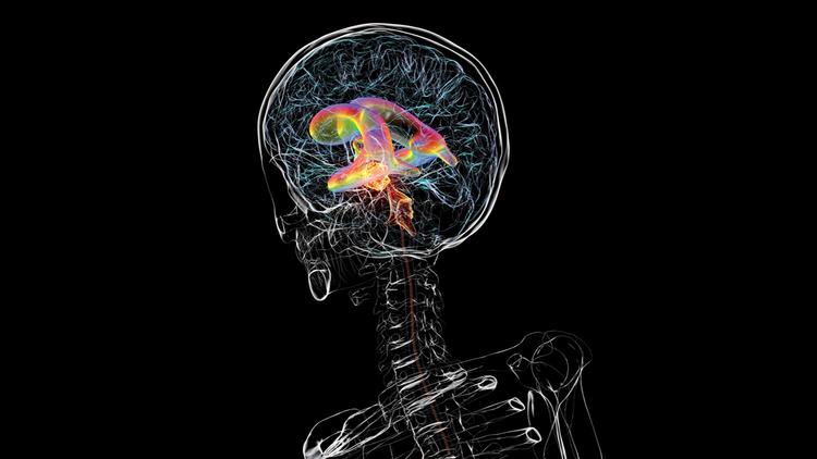 hidrocefalia de pressão normal idiopática