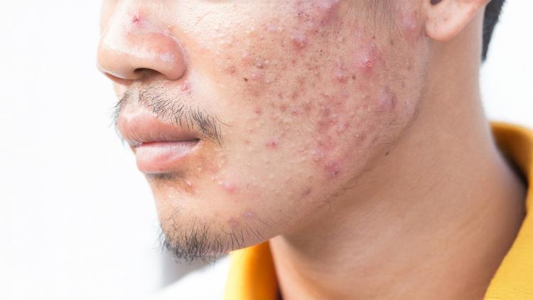 Insulina tópica é útil nas cicatrizes atróficas da acne?
