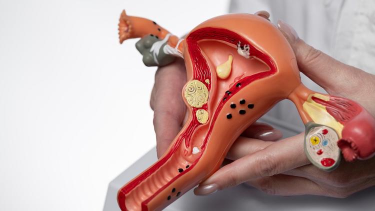 Miomectomia em miomas intramurais antes da FIV: o que dizem as evidências atuais?