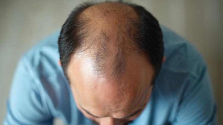 Degradador de receptor androgênico mostra sinal de eficácia na AGA