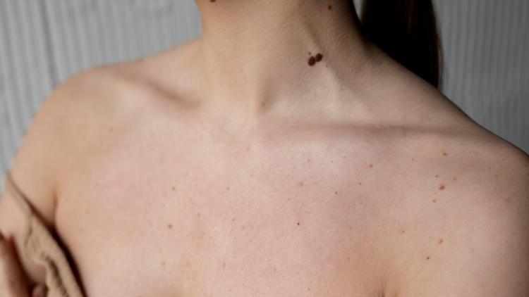 Câncer de pele melanoma: Como manejar?