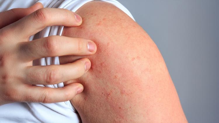 Rash cutâneo: abordagem clínica e diagnóstico diferencial