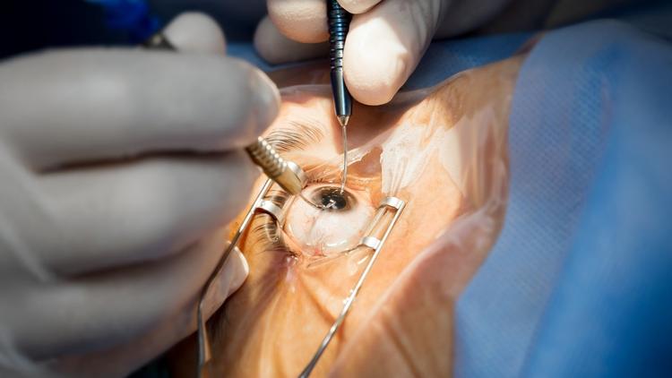 redução da ruptura na facoemulsificação