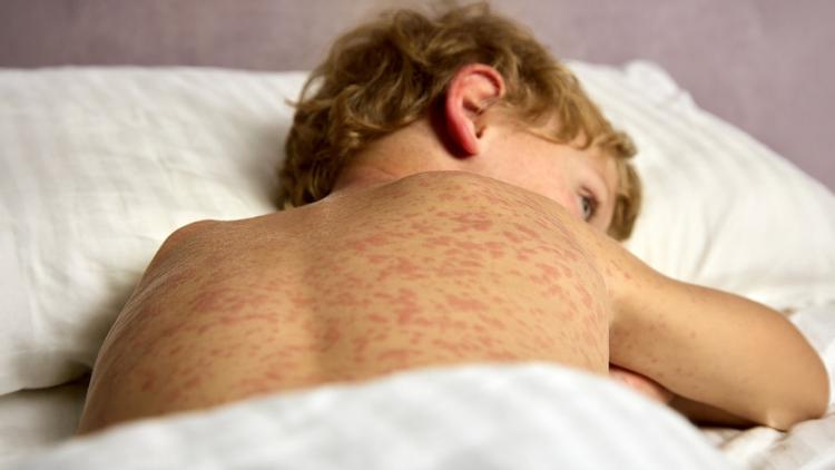 Casos de sarampo nas Américas aumentam 32 vezes em um ano