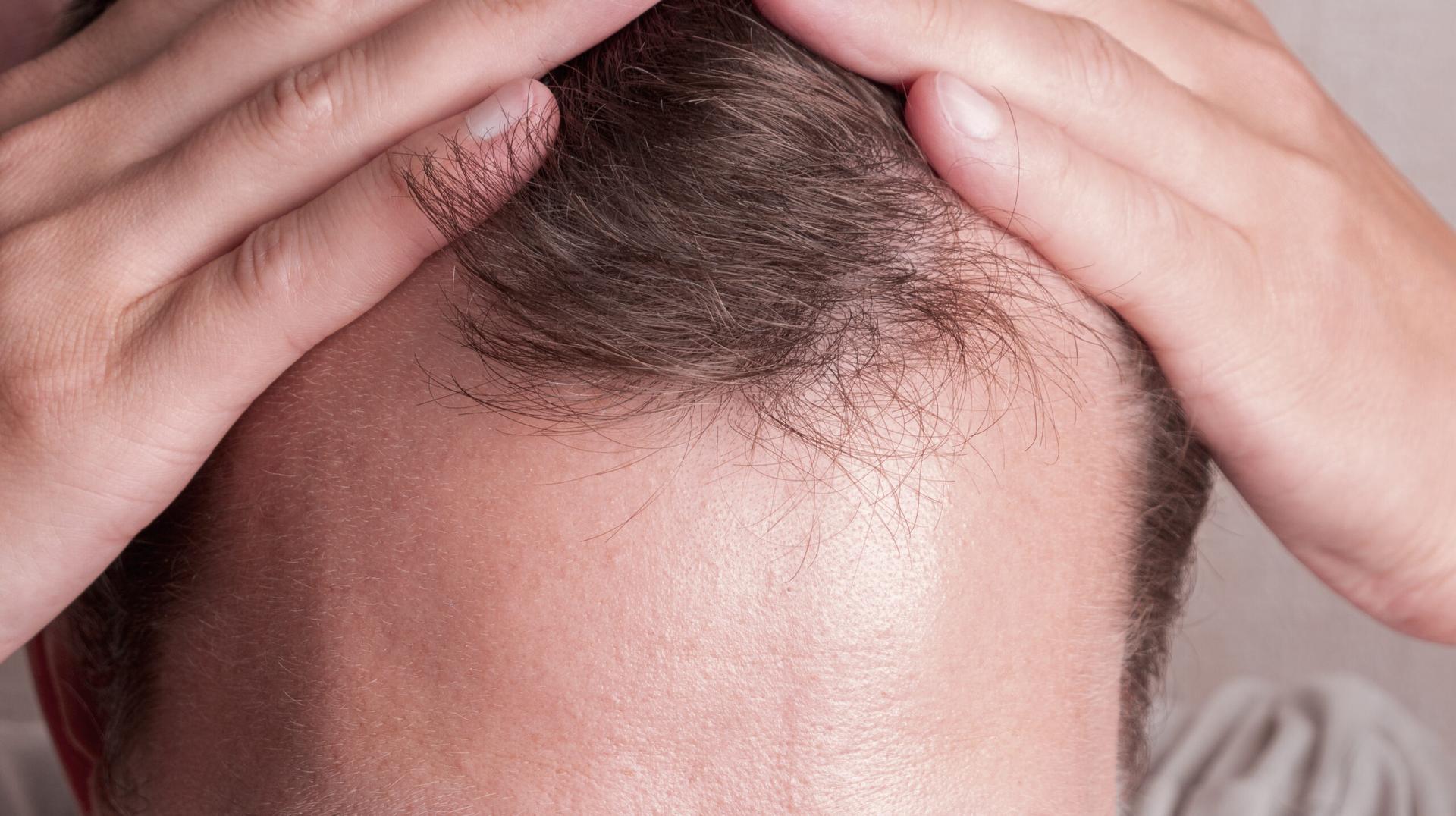Dutasterida no manejo da alopecia androgenética