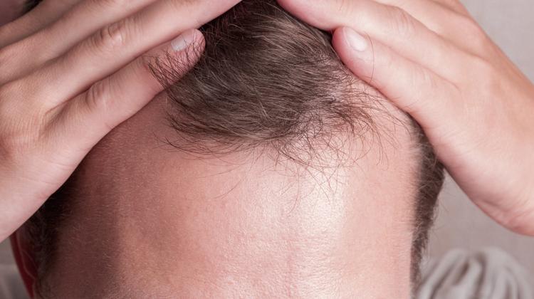 Dutasterida no manejo da alopecia androgenética