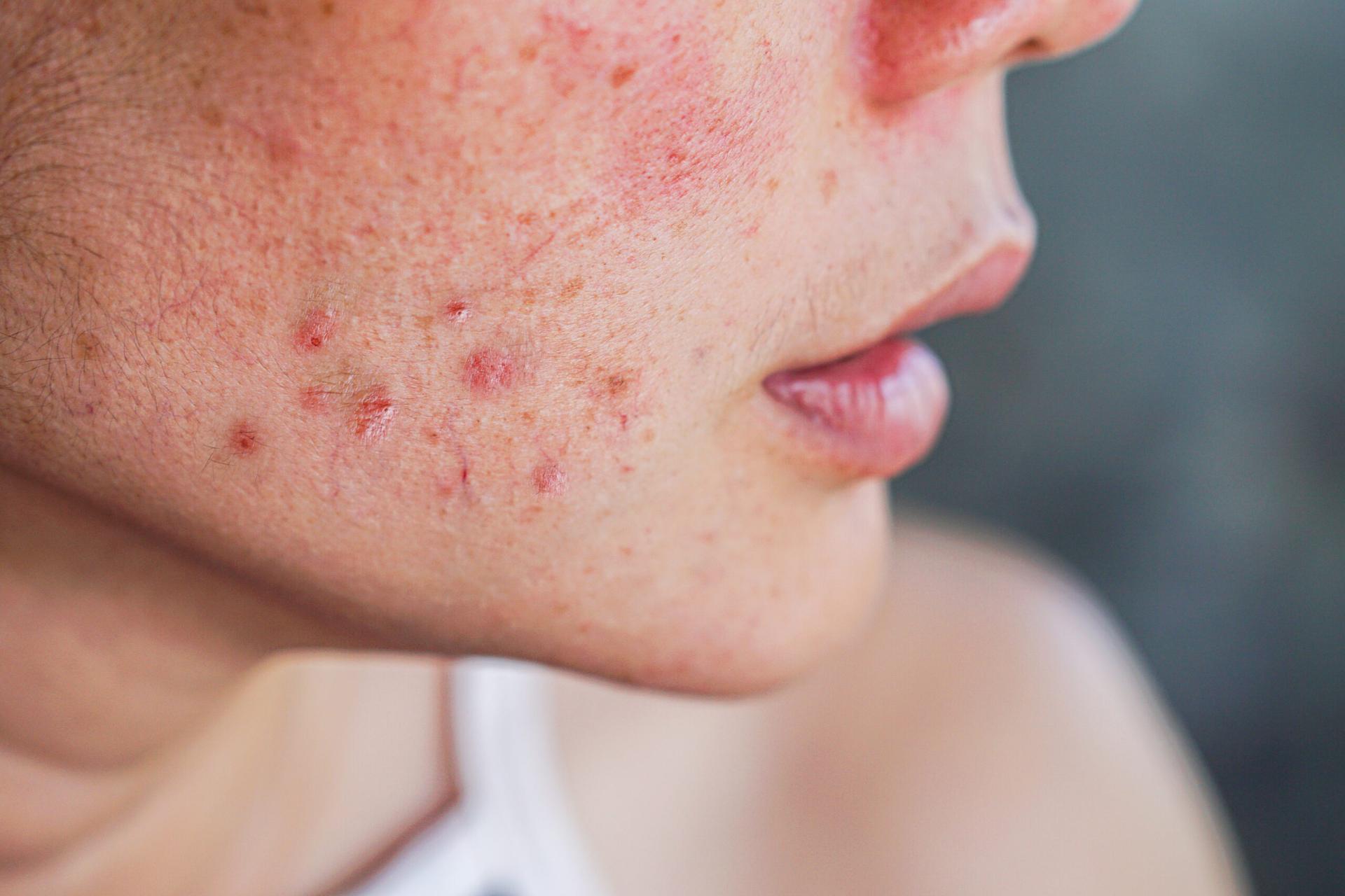 O papel dos antibacterianos tópicos e ácido retinoico no tratamento da acne e além