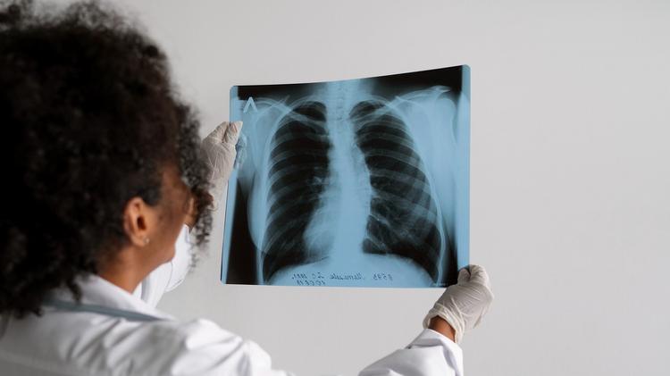 FDA amplia aprovação de novo medicamento para câncer de pulmão