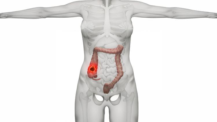 câncer colorretal tratamento adjuvante
