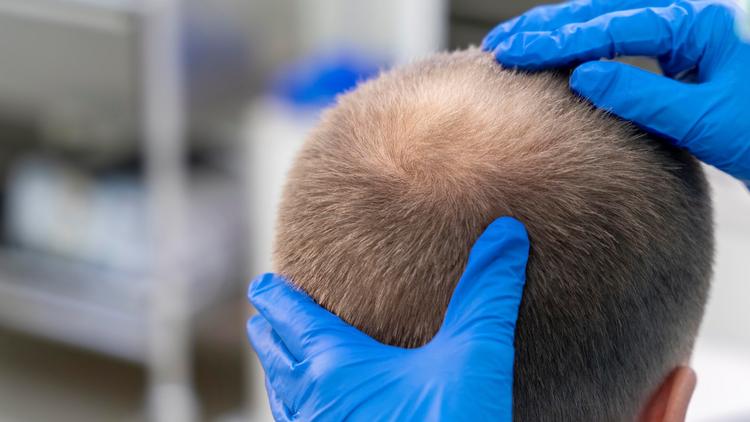 Alopecia areata: como promover o bem-estar nos pacientes?
