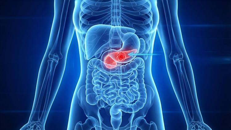 colecistomia na colecistite aguda