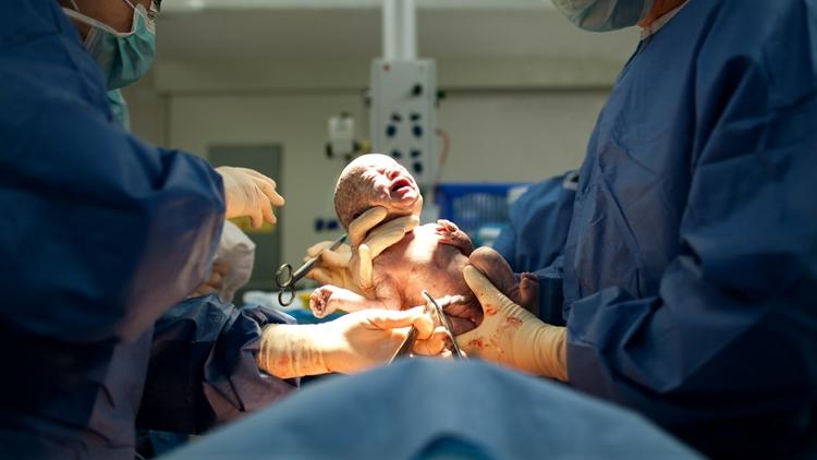 Clampeamento tardio na cesárea reduz mortalidade em prematuros extremos