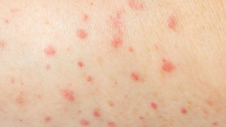 Novo caso de sarampo no Brasil em 2026