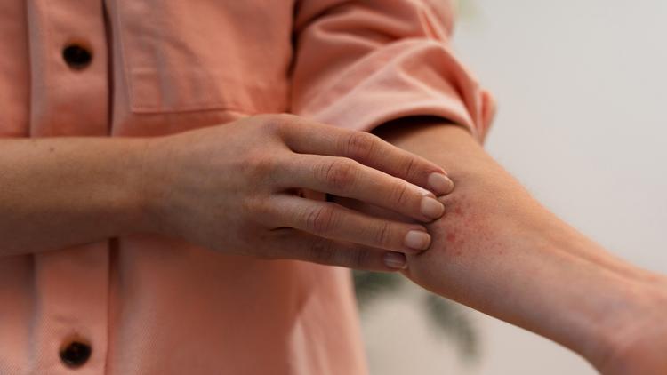 Hidratantes na dermatite aguda por radiação: revisão sistemática e meta-análise