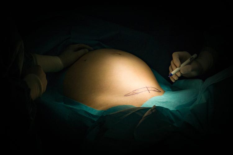 Obesidade materna e anestesia: como reduzir riscos obstétricos