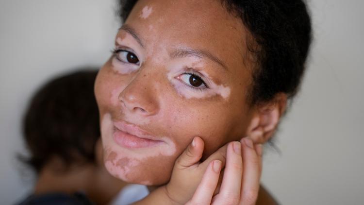 Vitiligo: Revisão sistemática avaliou crenças interculturais e estigmatização