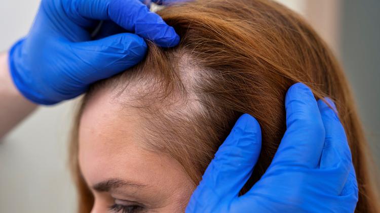 Queda de cabelo associada aos agonistas do receptor de GLP-1: quais as evidências?