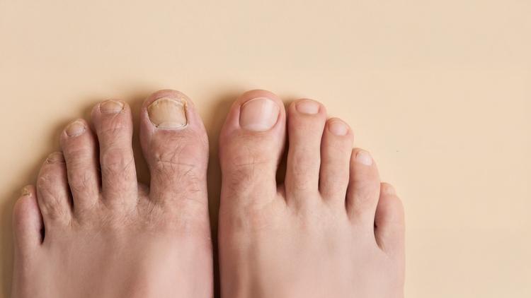 onicosquizia e onicorrexe em unhas