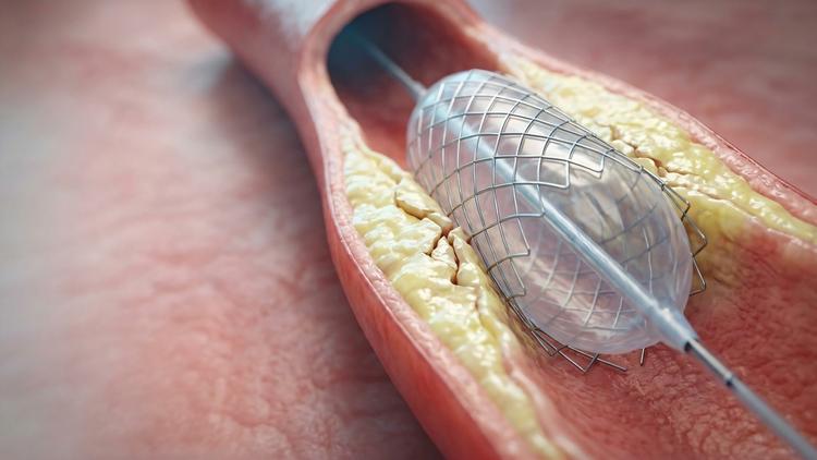 balão angioplastia na hptec
