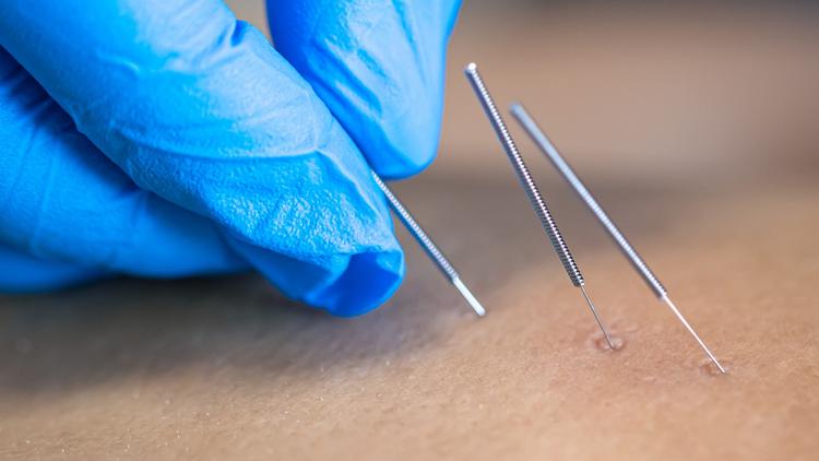 Eletroestimulação por acupuntura auxilia no tratamento da neuralgia pós-herpética?