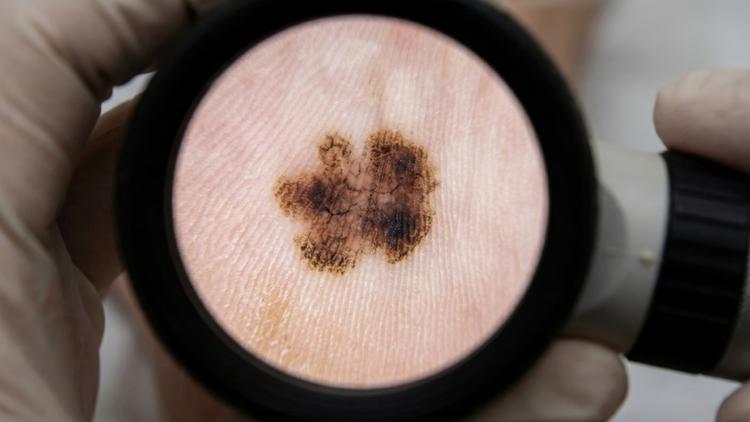 biópsia linfonodo melanoma