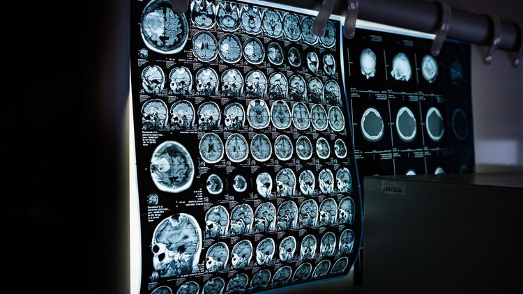 Estimativa do risco de ruptura de aneurismas intracranianos