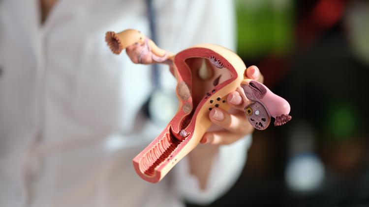 Kisspeptina e SOP: IMC potencializa desequilíbrio neuroendócrino